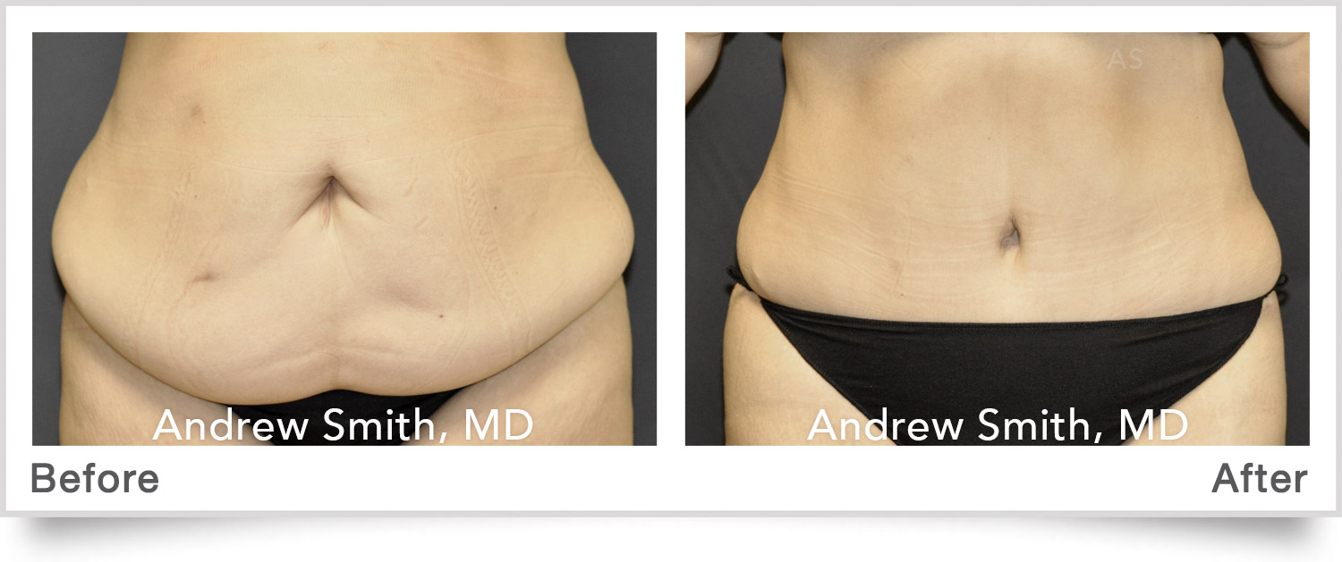 Tummy Tuck before and after photo, actual patient.