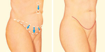 Tummy Tuck diagram